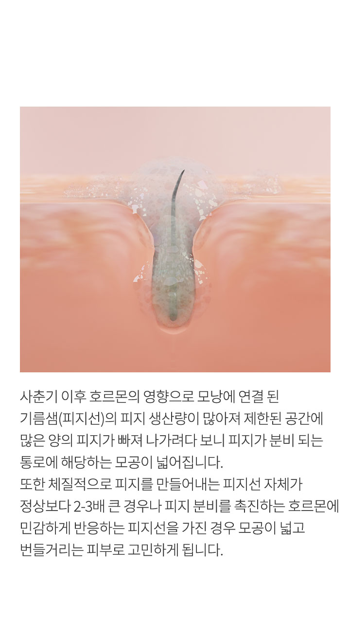 모공이 넓어지는 이유