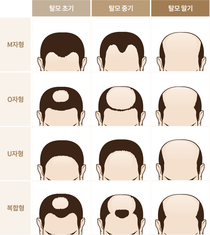 탈모의 유형