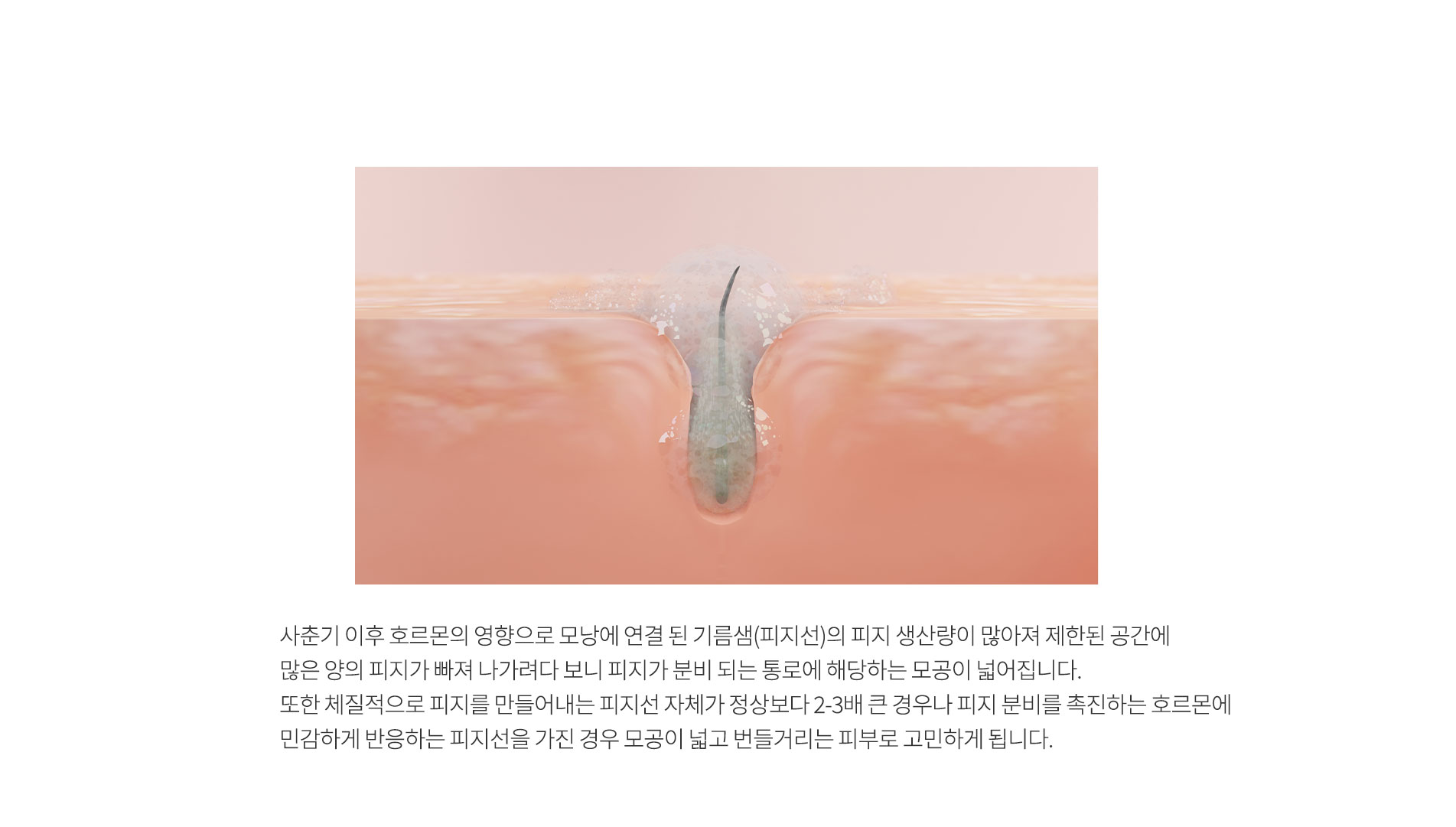 모공이 넓어지는 이유