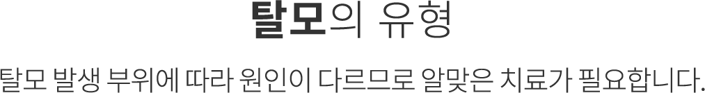탈모의 유형